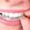 Treat of Invisalign with Affordable Cost at Townville Orthodontics