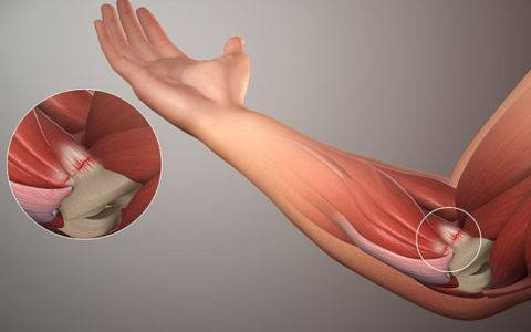 Orthopedic Conditions that Call for Elbow Surgery