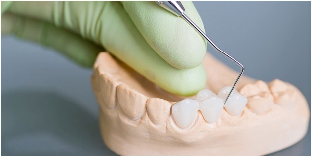 Dental Bridges and their Application